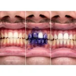 HiSmile V34 Colour Corrector Serum – Instantly Brighten & Whiten Your Smile